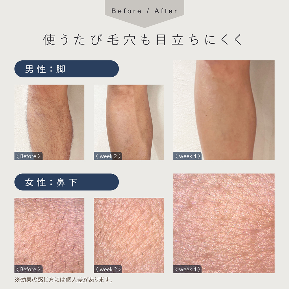 LINKA フレアタッチ プロ リンカ 脱毛器 脱毛 光美容 エステ 美顔器 美容機器 美容 美肌 ボディケア VIO 顔 脇 ワキ ヒゲ 家電 美容器 [EV34-NT]