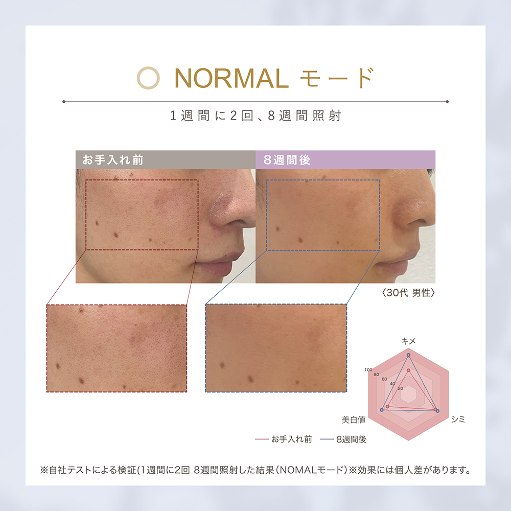 LINKA スノー フラッシュ（DPL_NIR 光美容器） LINKA リンカ 美顔器 美白 美容 スキンケア 美容家電 エステ フォトフェイシャル [EV07-NT]