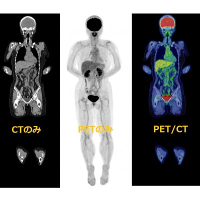 PET-CT総合がん検診(脳検査付)【1303247】