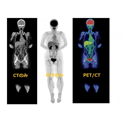 PET-CT総合がん検診(乳がん・子宮がん検査付)【1303249】