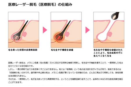 お試し 女性脱毛 パーフェクト 全身コース 1回 VIO 顔含む 藤沢院／SBC 湘南 美容 クリニック ふるさと納税 脱毛 医療 レーザー 利用券 チケット 神奈川県 藤沢市