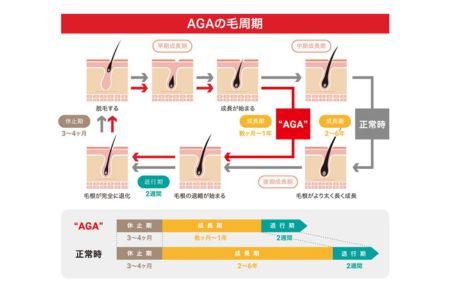 AGAによる薄毛リスクが、髪の毛数本でわかる！【毛髪ホルモン量測定キット（DHT）】