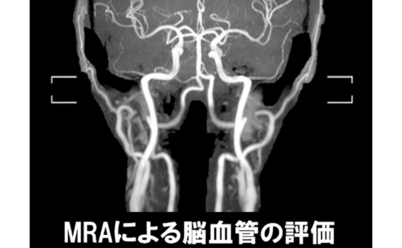 簡易脳ドック受診券1名分 脳ドック 利用 クーポン券 健康診断 チケット 人間ドック 浜松PET診断センター 検診 MR検査 超音波検査 血液検査 静岡 浜松市