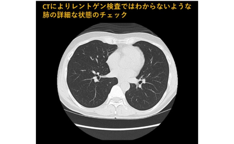 肺がんCT検診受診券1名分 肺がんCT 利用 クーポン券 健康診断 チケット 人間ドック 浜松PET診断センター 検診 CT検査 静岡 浜松市