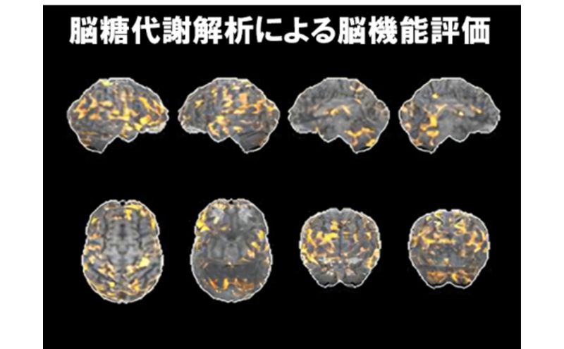 PETがん検診/総合コース+脳オプション受診券1名分 がん PET 脳 利用 クーポン券 健康診断 チケット 人間ドック 浜松PET診断センター 検診 PET CT MRI 超音波 画像診断 MRA検査 神経心理テスト 脳糖代謝解析 静岡 浜松市