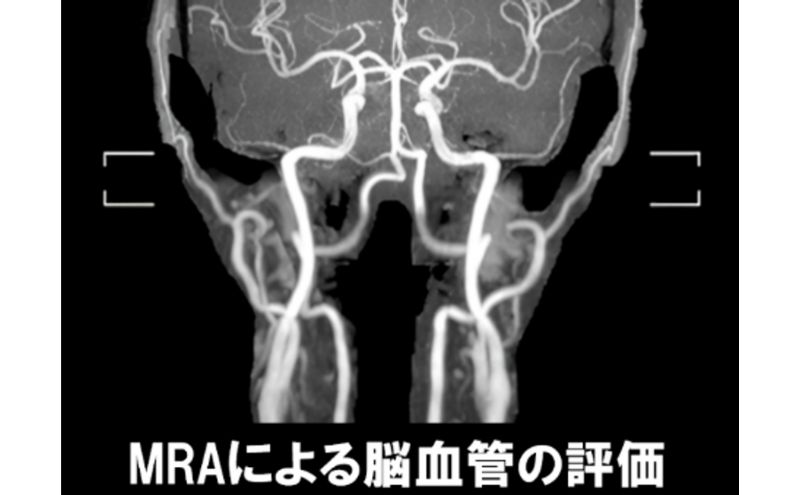 PETがん検診/総合コース+脳オプション受診券1名分 がん PET 脳 利用 クーポン券 健康診断 チケット 人間ドック 浜松PET診断センター 検診 PET CT MRI 超音波 画像診断 MRA検査 神経心理テスト 脳糖代謝解析 静岡 浜松市