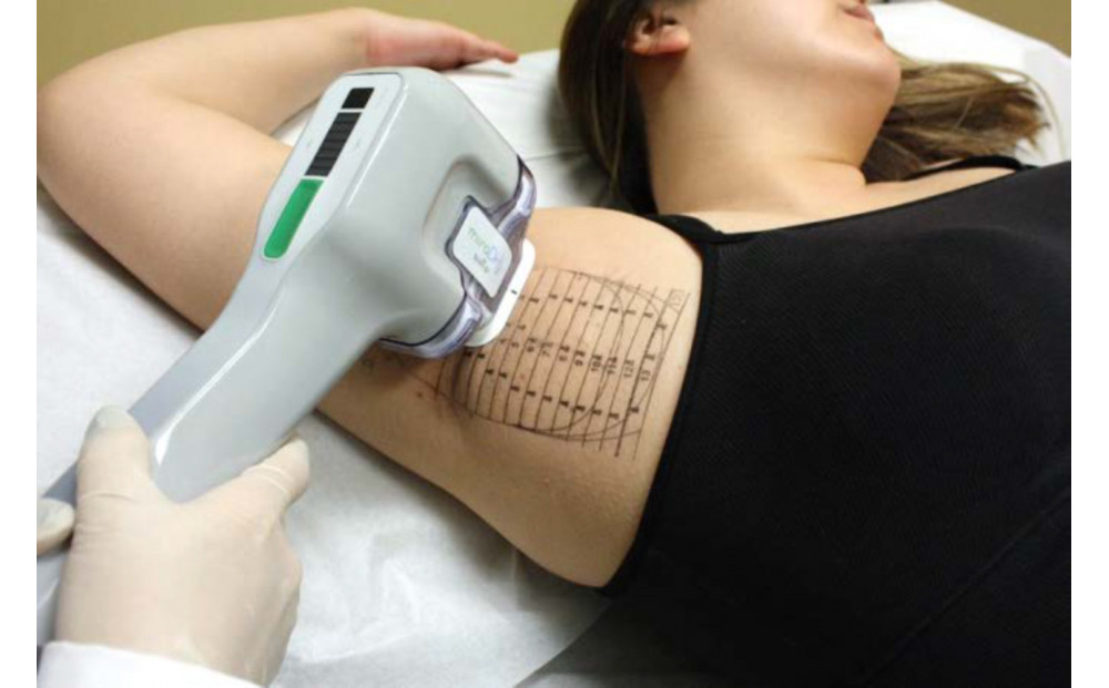 【切らないワキガ治療】ミラドライ（両脇）【ダブル照射】　広範囲照射