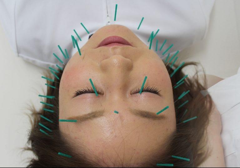 はじめての美容鍼体験チケット